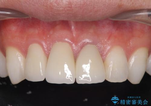 前歯の変色 審美性の改善の症例 治療後