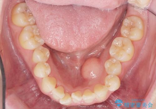 矯正の後戻りを防ぐ骨隆起の切除の治療後