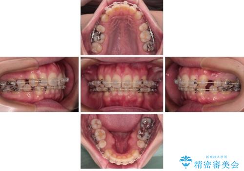 口元が出ているのが気になる。審美装置による抜歯矯正の治療中