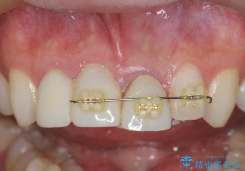 前歯の変色　審美性の改善の治療中