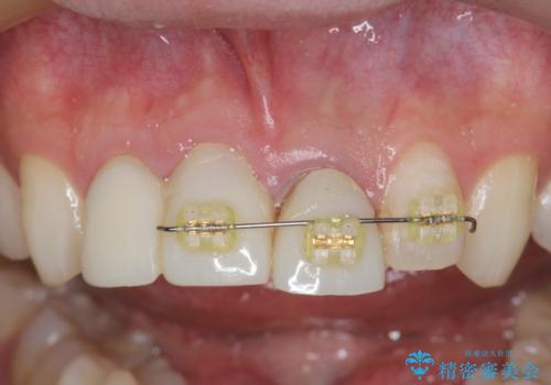 前歯の変色 審美性の改善の治療中