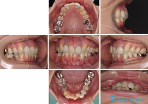 非対称の前歯を整えたい　矯正治療と審美治療の総合歯科診療の治療前