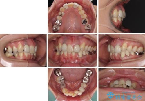 非対称の前歯を整えたい 矯正治療と審美治療の総合歯科診療の治療前