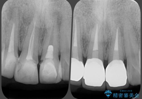 前歯の変色　審美性の改善