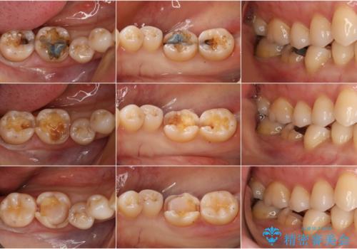 深い虫歯を綺麗なセラミックで修復!の治療中