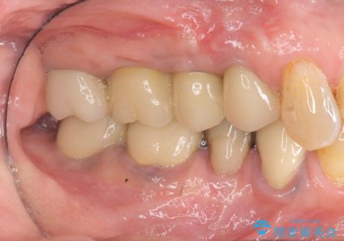 過大な咬合力で破折した奥歯 インプラント治療で咬合機能の回復の治療後