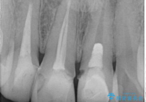 前歯の変色 審美性の改善の治療前