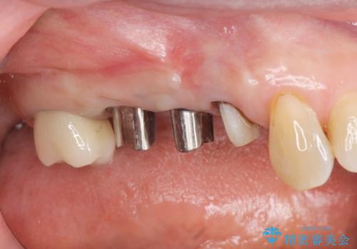 過大な咬合力で破折した奥歯　インプラント治療で咬合機能の回復の治療中