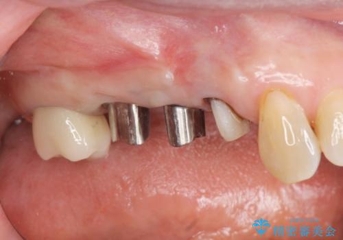 過大な咬合力で破折した奥歯 インプラント治療で咬合機能の回復の治療中