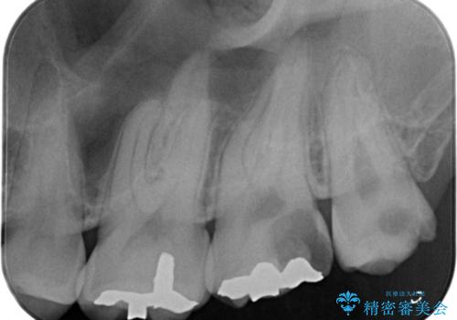 奥の虫歯 ジルコニアクラウンでの修復の治療前