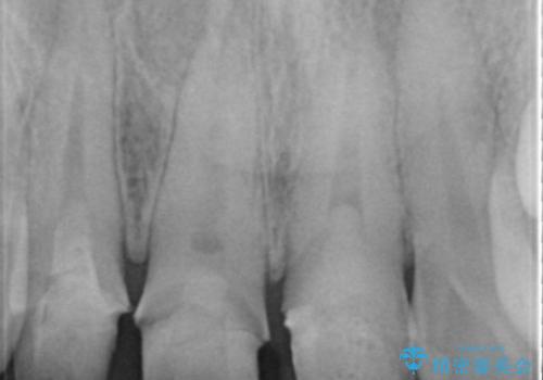 前歯の変色　審美性の改善の治療前