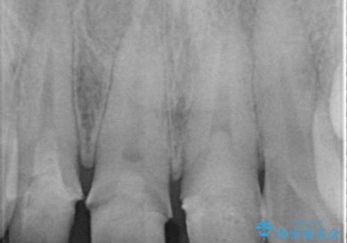 前歯の変色 審美性の改善の治療前