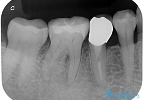 食べ物が引っかかるからやり替えたい セラミックインレー修復の治療後