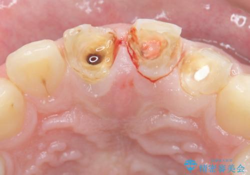 前歯の変色 審美性の改善の治療前