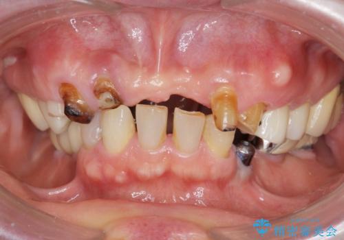 咬合の崩壊 金属床義歯で咬合機能の回復の治療前