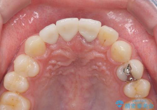 前歯の変色 審美性の改善の治療後