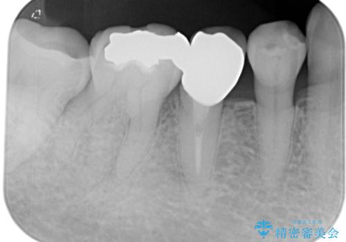 食べ物が引っかかるからやり替えたい セラミックインレー修復の治療前