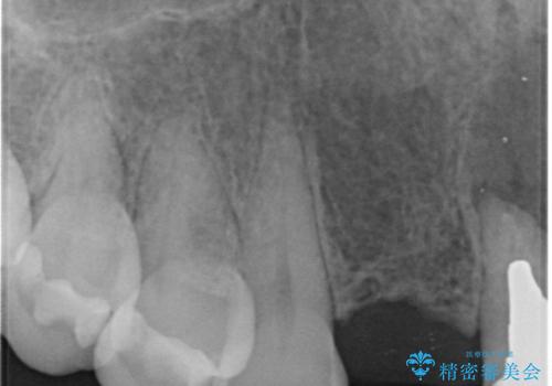 入れ歯を変えたい ブリッジでの修復治療の治療前
