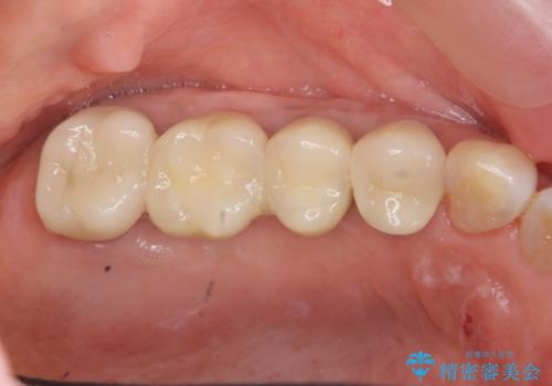 過大な咬合力で破折した奥歯　インプラント治療で咬合機能の回復の治療後