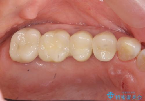 過大な咬合力で破折した奥歯 インプラント治療で咬合機能の回復の治療後