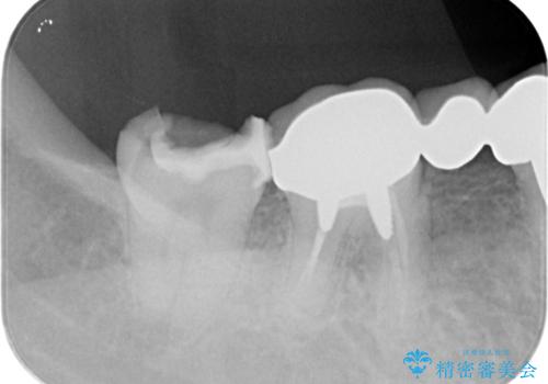 インレー下に再発した虫歯 セラミッククラウンによるやり替えの治療前