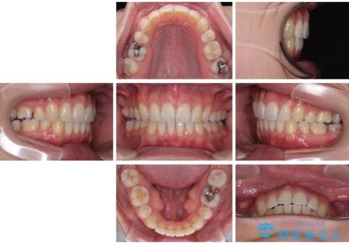 口元が出ているのが気になる。審美装置による抜歯矯正の治療後