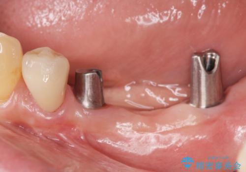 入れ歯を無くした インプラント治療の希望の治療中