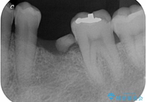 奥歯の欠損　インプラント治療の治療前
