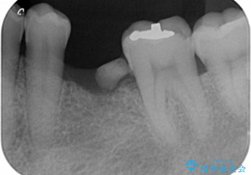 奥歯の欠損 インプラント治療の治療前