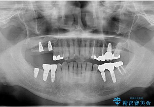 歯が割れているといわれた 奥歯にインプラントをしていきたい 全体的な治療の治療中