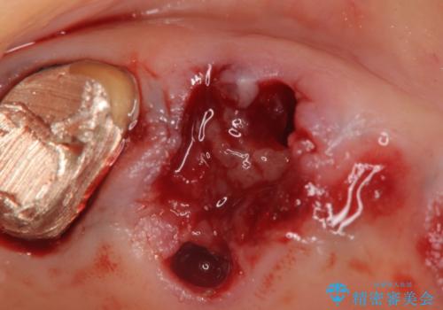 過大な咬合力で破折した奥歯 インプラント治療で咬合機能の回復の治療前