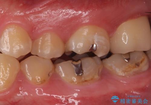 奥の虫歯 ジルコニアクラウンでの修復の治療後