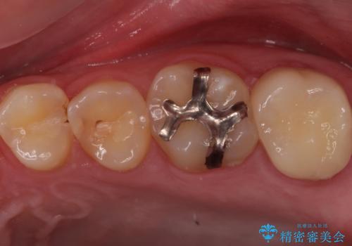 奥の虫歯 ジルコニアクラウンでの修復の症例 治療後