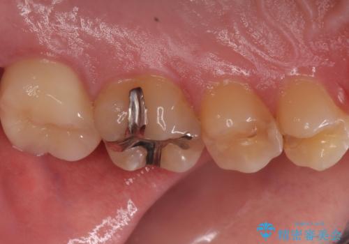 奥の虫歯 ジルコニアクラウンでの修復の治療後