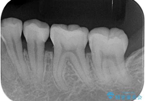コンタクトカリエスの治療後