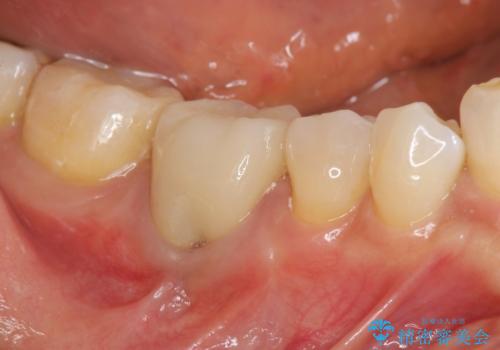 目立つ銀歯を除去したい メタルフリー治療の希望の治療後