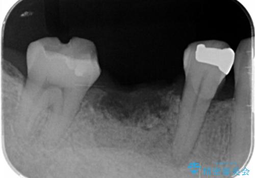 歯槽堤保存術 → インプラント治療の治療中