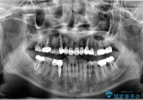 歯並びと虫歯(メタルフリー)を行った全顎治療の治療後