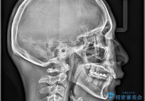 【インビザライン　非抜歯】歯の捻じれと歯のでこぼこを治したい!の治療前