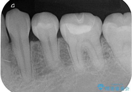 詰め物の下が黒いのが気になる　セラミックインレー修復の治療後