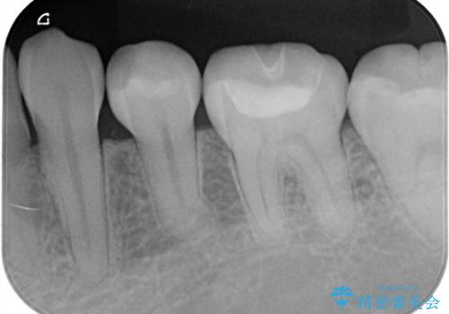 詰め物の下が黒いのが気になる セラミックインレー修復の治療後