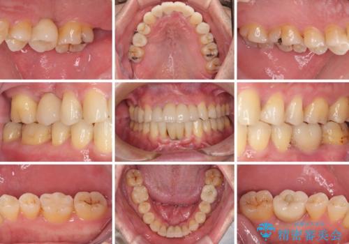 放置した歯列　矯正治療とインプラント治療で劇的に改善の治療後