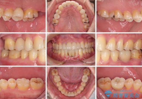 放置した歯列 矯正治療とインプラント治療で劇的に改善の治療後