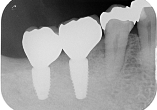 大臼歯　2本インプラントで自分の歯と同じくらい噛めるようにの治療後