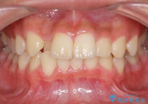 抜歯矯正の長期予後(術後8年目)の症例 治療前