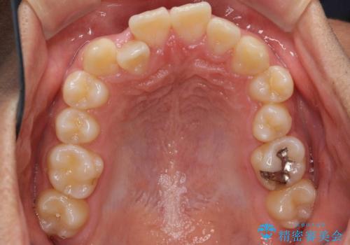 抜歯矯正の長期予後(術後8年目)の治療前