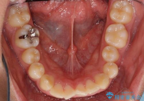 抜歯矯正の長期予後(術後8年目)の治療前