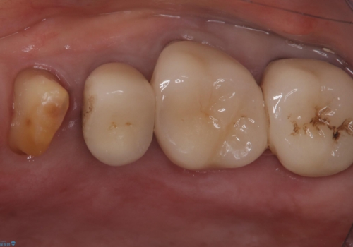 【セラミッククラウン】昔入れた被せものの黒いところが気になるの治療中