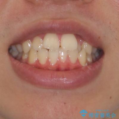 突出した口元 ワイヤー装置で横顔の印象を改善の治療前(顔貌)