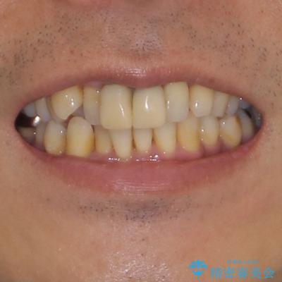 八重歯と突出感を改善 ワイヤー装置での矯正治療の治療前(顔貌)